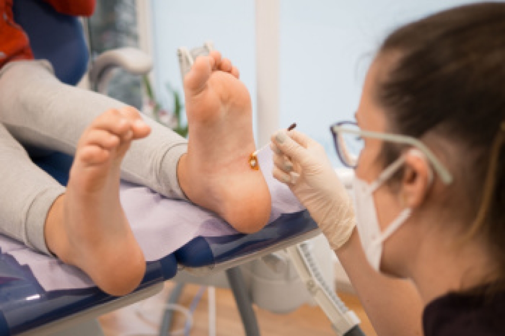 Who Commonly Develops Plantar Warts