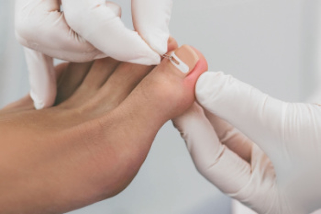 Painful Ingrown Toenails and Effective Treatment