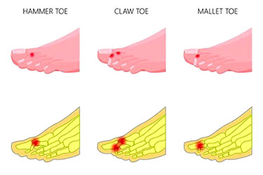 hammertoe