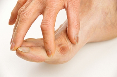 Finding Relief from Bunion Discomfort