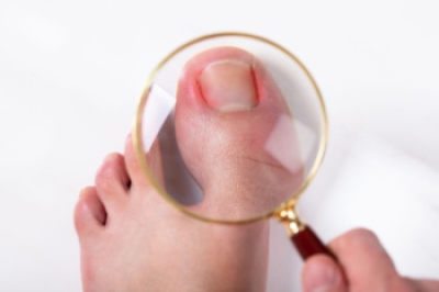 Ingrown Toenail Facts