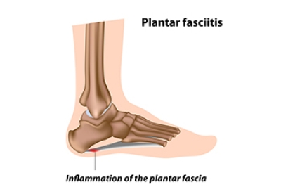 Plantar Fasciitis and Heel Spur Syndrome