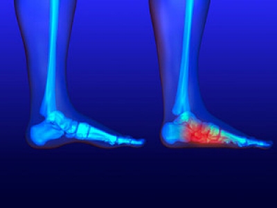 Diagnosis and Management of Flat Feet