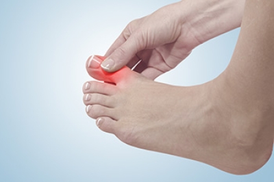Gout and Its Impact on the Big Toe