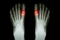 Understanding Pediatric Gout