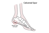 What Is a Heel Spur?