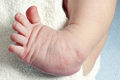 Clubfoot Symptoms