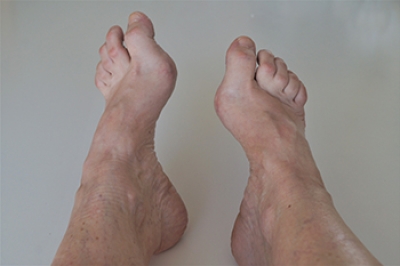 Symptoms and Treatment of High Arched Feet